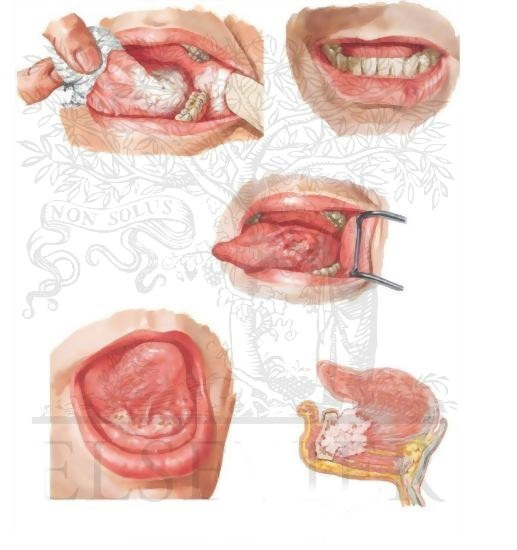 Oral Cancer