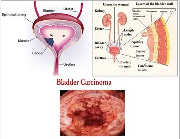 Urinary bladder