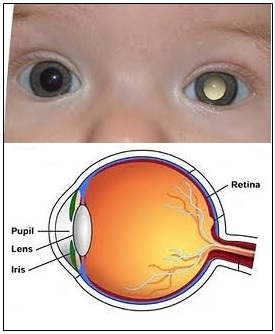 Retinoblastoma