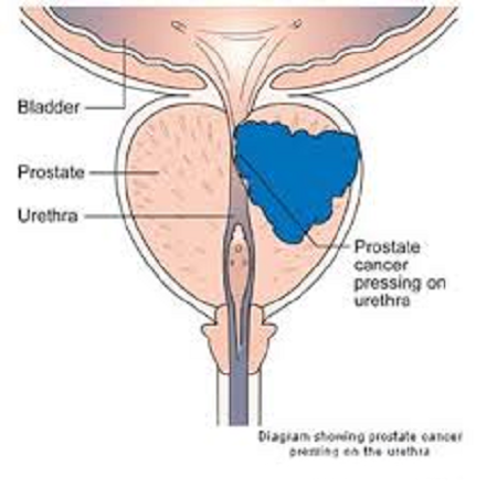 Prostate