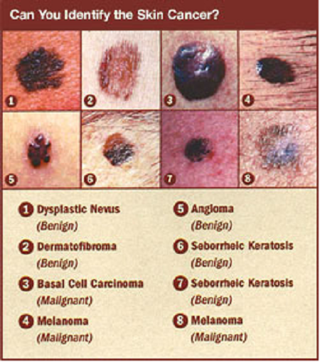 Skin Cancer